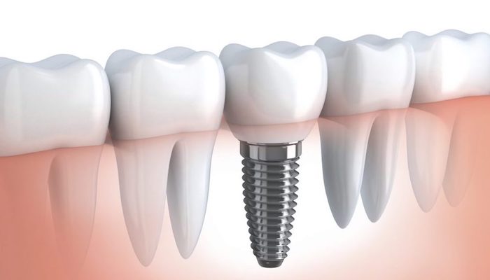 Impianti dentali: una soluzione utile o abusata?