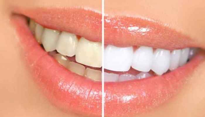 Perché avere i denti bianchi?