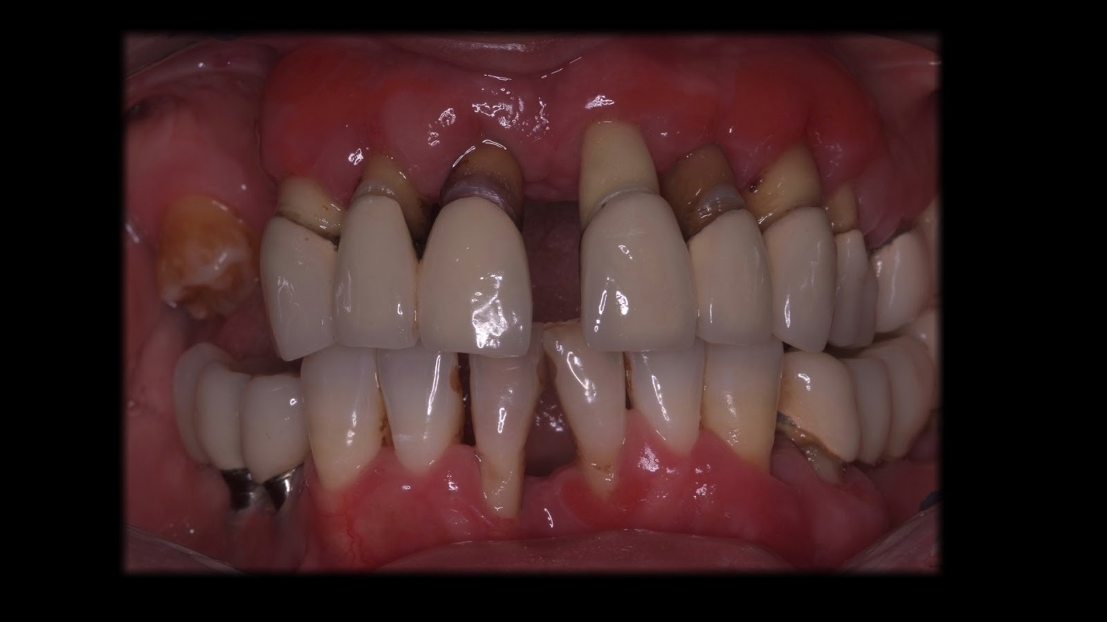 Parodontite: Salviamo o togliamo i denti?